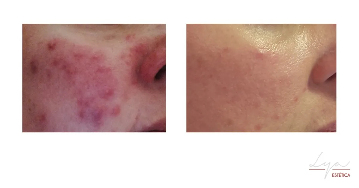 Tratamiento Acné Biologique Recherche